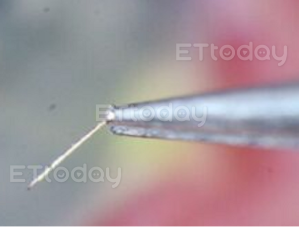 ▲醫師在裂隙燈下使用鑷子，將極細的蜂針取出。（圖／洪啟庭醫師提供）