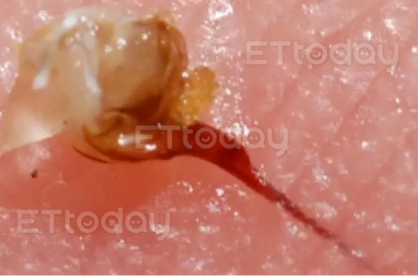 ▲蜜蜂螫針插入眼皮，卡在皮膚內 。（圖／洪啟庭醫師提供）