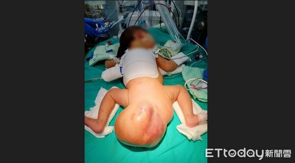 ▲屁股比頭還大！女嬰患罕見畸胎瘤風暴長大4倍　「超巨大腫瘤」畫面驚人。（圖／中港澄清醫院提供）