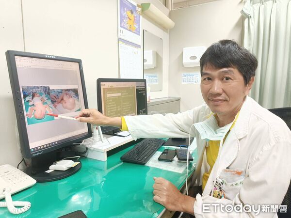 ▲屁股比頭還大！女嬰患罕見畸胎瘤風暴長大4倍　「超巨大腫瘤」畫面驚人。（圖／中港澄清醫院提供）