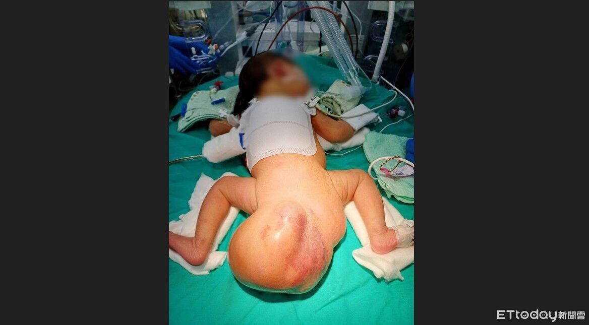 女嬰患罕見畸胎瘤暴風式長大　「16cm超巨大腫瘤」驚人畫面曝