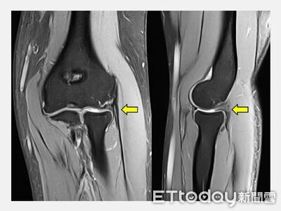 35歲女會計師手肘痛！3年找不出原因　醫揪「隱藏病灶」才根治