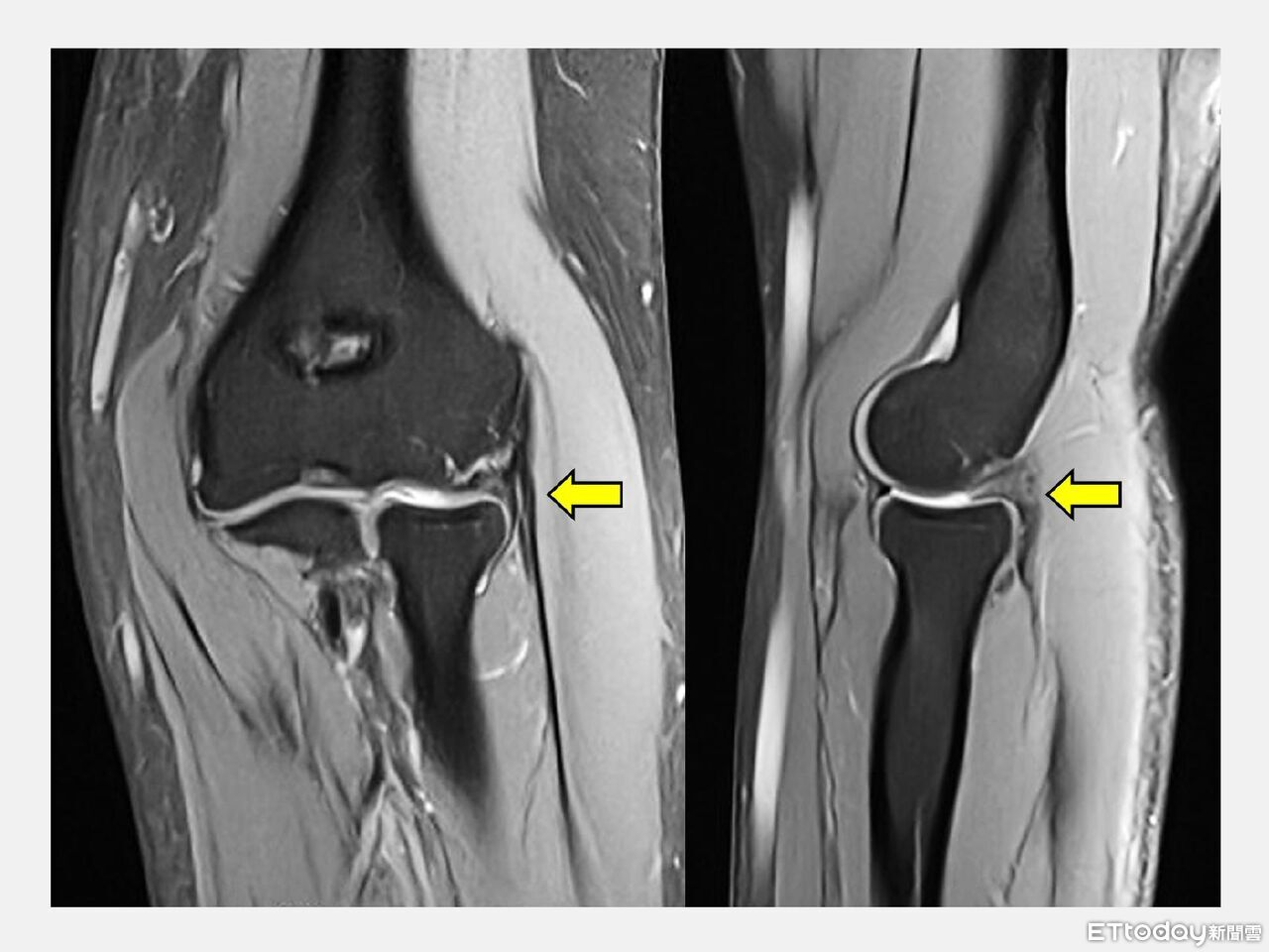 35歲女會計師手肘痛！3年找不出原因　醫揪「隱藏病灶」才根治