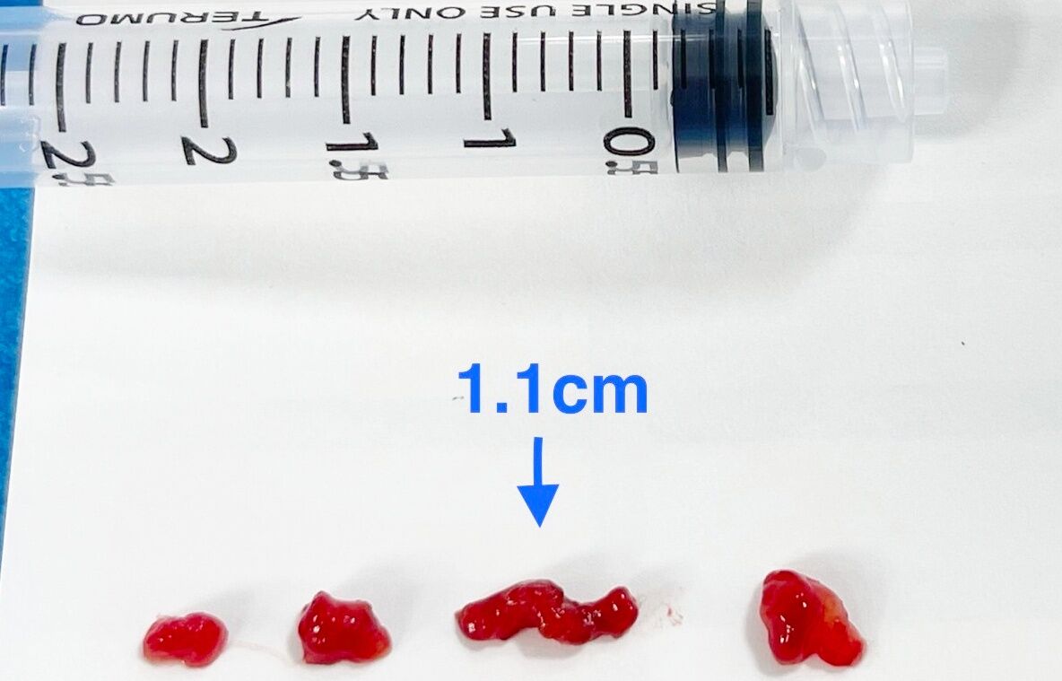 14歲國中生上課突倒地！送醫取出4血栓救回一命　最大1.1cm