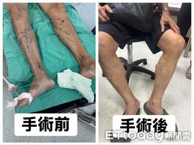 長時間站立致靜脈曲張 雷射手術快速緩解疼痛