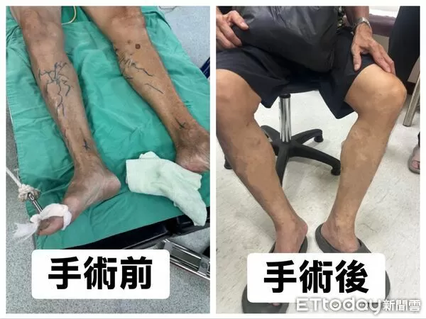 ▲▼   嘉榮雷射手術治療靜脈曲張　隔日就能下床行走  。（圖／嘉義榮民醫院提供）