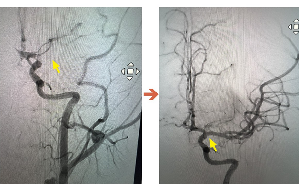 ▲14歲學子課堂突倒地，醫完成顱內取栓救回大腦