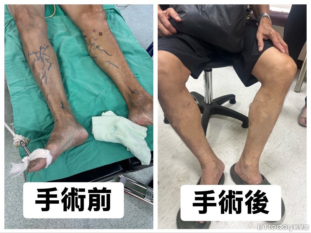 長時間站立致靜脈曲張 　雷射手術快速緩解疼痛