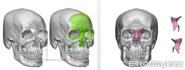 ▲▼ 槍傷            。（圖／三軍總醫院提供）