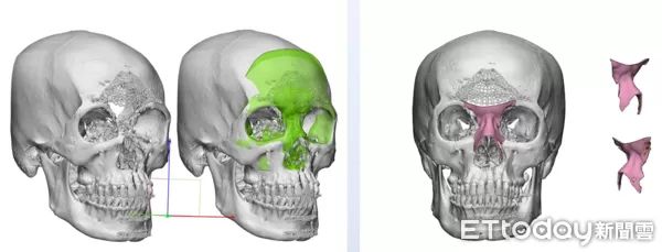 ▲▼ 槍傷            。（圖／三軍總醫院提供）
