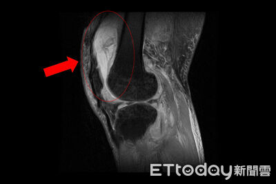 男關節腫到不能走 竟是「結核菌」入侵