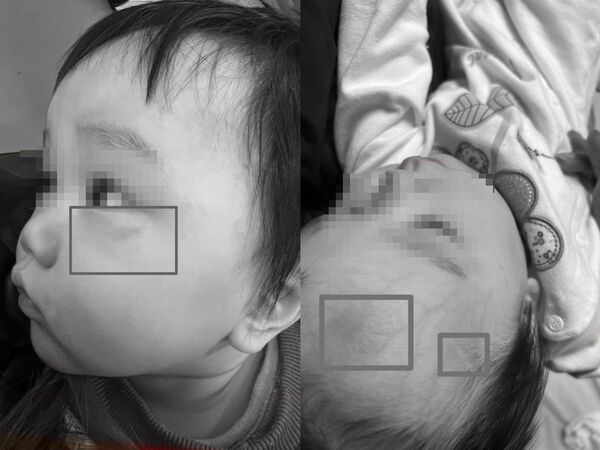 ▲陳姓媽媽指出兒子額頭及眼部下方都有瘀青 。（圖／民眾提供）