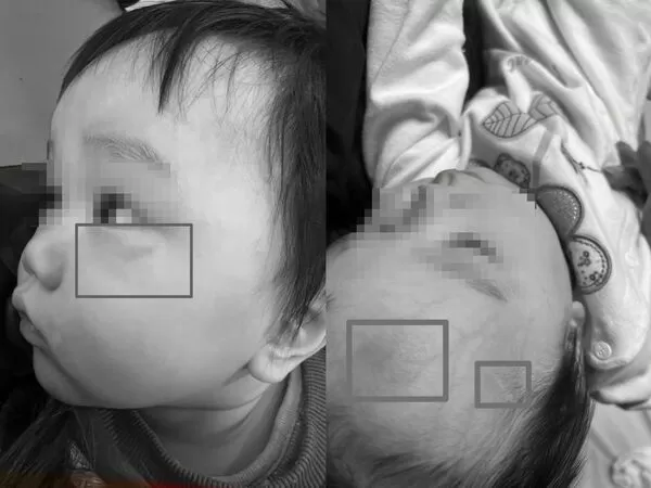 ▲陳姓媽媽指出兒子額頭及眼部下方都有瘀青 。（圖／民眾提供）