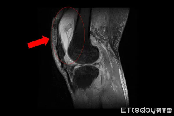 台中慈濟醫院關節中心主任周立展、肺外結核感染。（圖／院方提供）