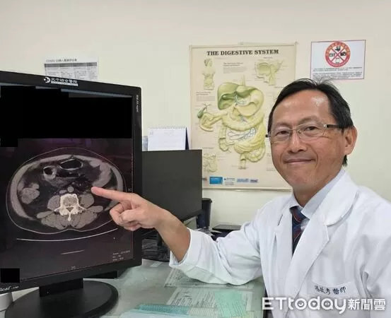 ▲苗栗65歲老翁自行灌腸，不慎造成腸破裂、糞水亂流引發腹膜炎，送醫手術後救回一命。（圖／大千綜合醫院提供）