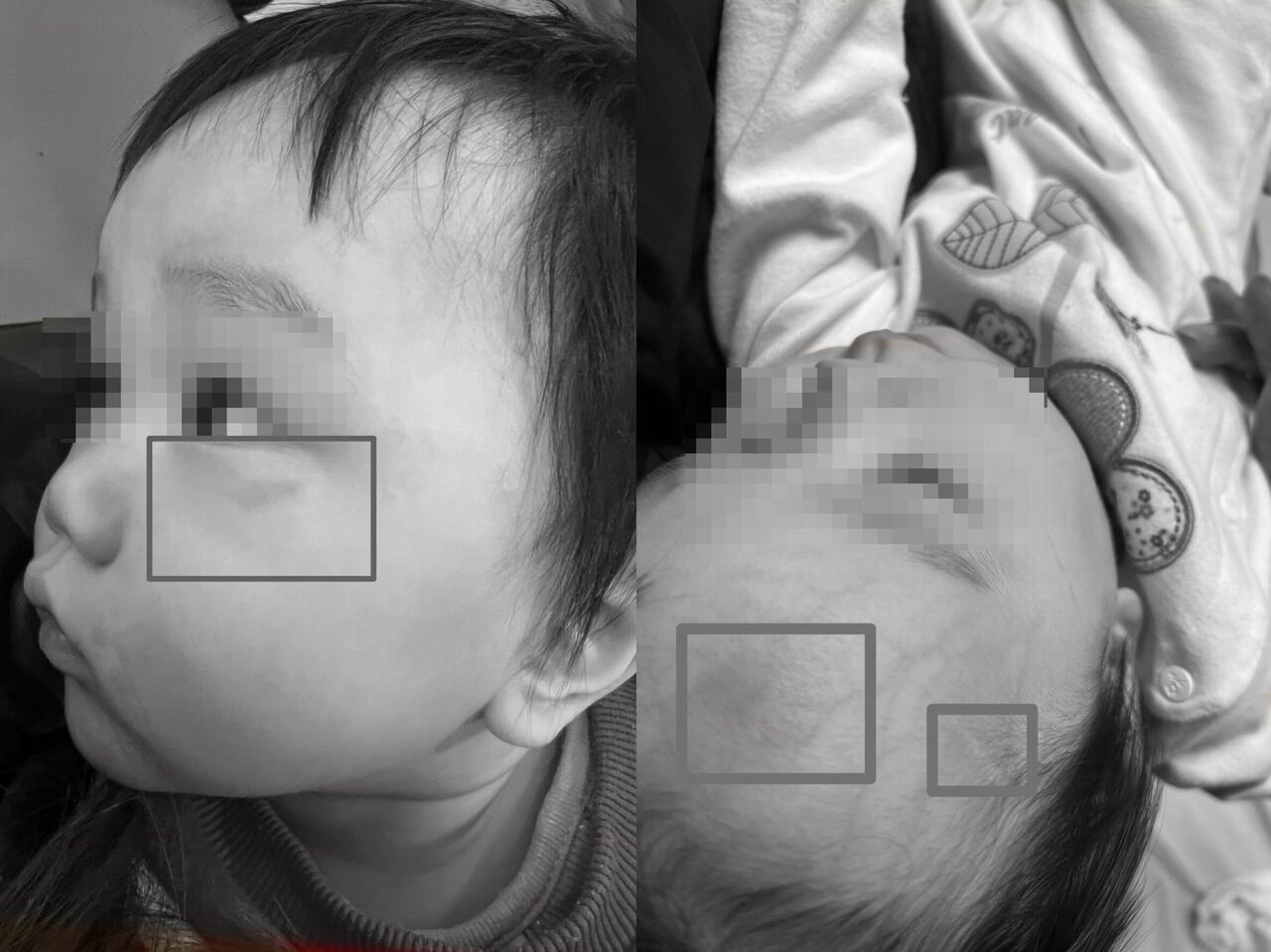 1歲兒被安置疑受虐!社工扯謊三度改口 母想到剴剴案不忍了