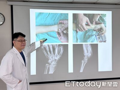 女大生打排球飛撲手腕韌帶撕裂　PRP合併復位手術3個月重返球場