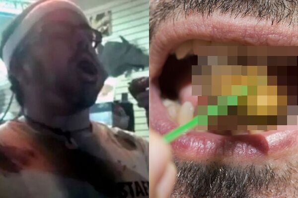 比賽生吞活蟑螂！　美32歲男「蟲屍卡呼吸道」窒息慘死