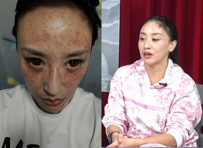 安歆澐發不自殺聲明!「老公拿刀家暴」勒脖到腦缺氧 臉部血管大爆裂