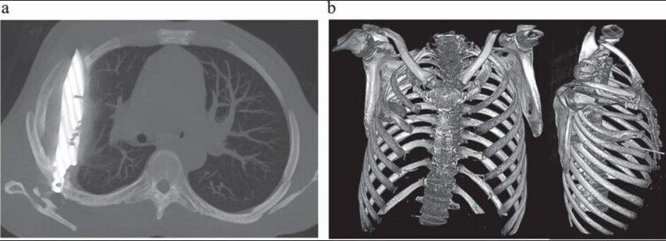▲▼乳頭旁恐怖流膿「竟是刀插體內8年」　他一照X光片嚇壞醫師（圖／翻攝academic.oup.com）
