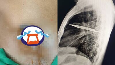 乳頭恐怖流膿「竟是刀插體內8年」　他一照X光片嚇壞醫師