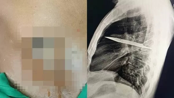 ▲▼乳頭旁恐怖流膿「竟是刀插體內8年」　他一照X光片嚇壞醫師（圖／翻攝academic.oup.com）