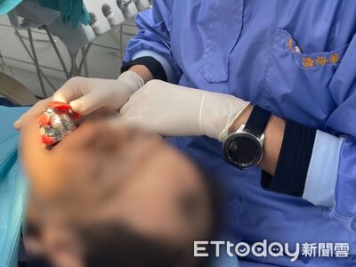 只能張口2公分！口腔癌患盼能吃飯、微笑　醫1技術神救援