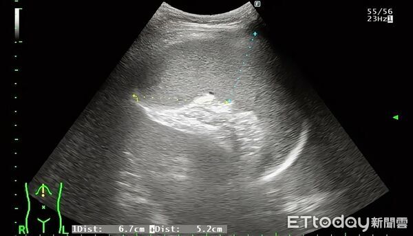 ▲▼男童肝臟與脾臟異常腫大。（圖／張靖醫師授權提供）