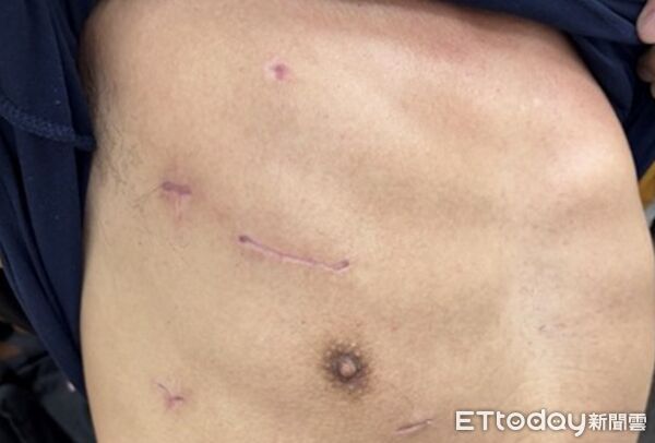 北榮患者經右側肋間內視鏡微創瓣膜手術傷口小於5公分。（圖／記者趙于婷攝）