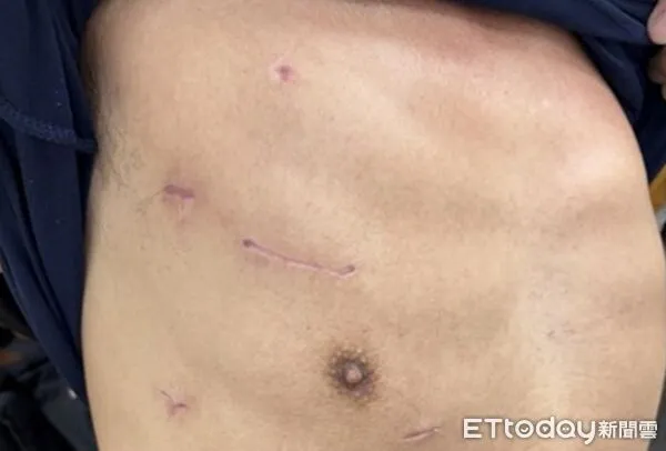 北榮患者經右側肋間內視鏡微創瓣膜手術傷口小於5公分。（圖／記者趙于婷攝）
