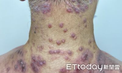 異位性皮膚炎長年「抓到皮膚潰爛」　醫：四分之一成年後發病