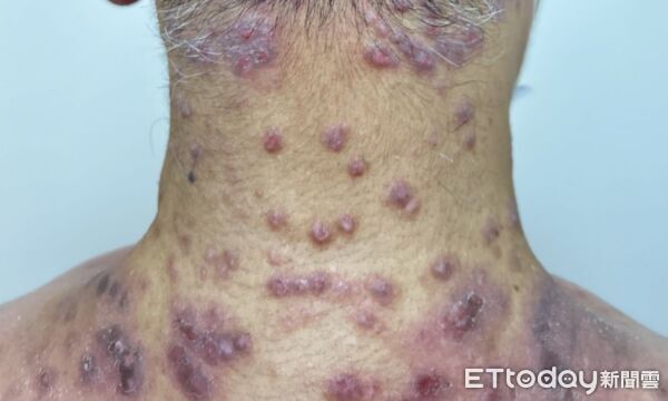 異位性皮膚炎患者。（圖／台北慈濟醫院提供）