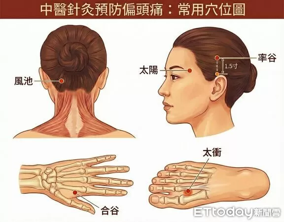 ▲▼     針灸        。（圖／周文程醫師提供）