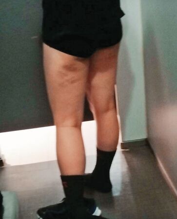 許詩穎在南英商工宿舍被教練打到大腿瘀青。（許詩穎提供）