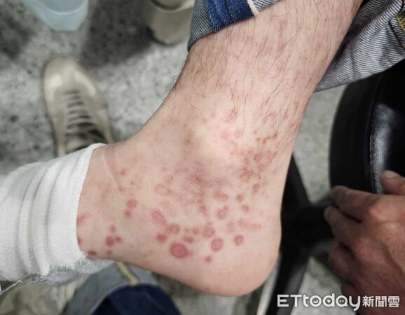 ▲▼露營完「手掌全紅斑」！他崩潰問AI：是梅毒　掛泌尿科全認了。（圖／蘇信豪醫師授權提供）