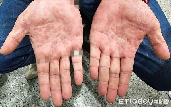 ▲▼露營完「手掌全紅斑」！他崩潰問AI：是梅毒　掛泌尿科全認了。（圖／蘇信豪醫師授權提供）