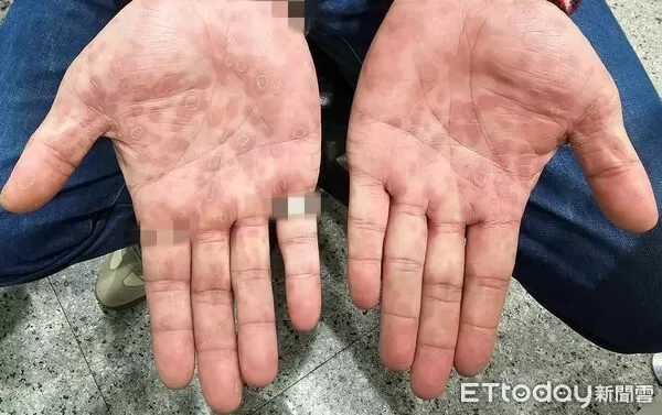 ▲▼露營完「手掌全紅斑」！他崩潰問AI：是梅毒　掛泌尿科全認了。（圖／蘇信豪醫師授權提供）