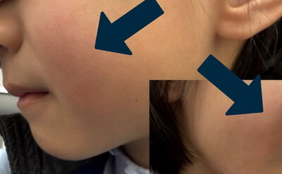 「蘋果病」又出現！　醫：感覺像被打兩巴掌