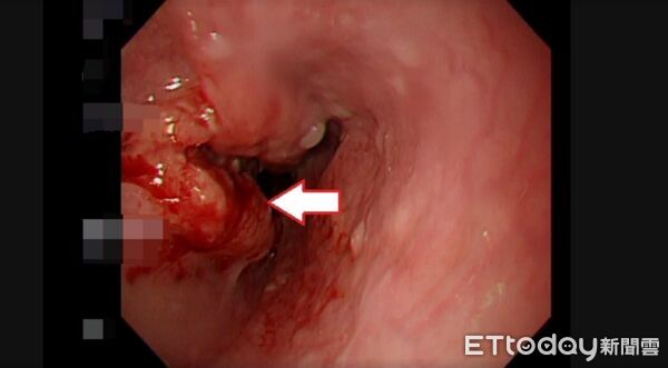 ▲以為胃食道逆流！男子喝水卡卡赫見「癌症3期」 食道慘切除。（圖／亞大附醫提供）