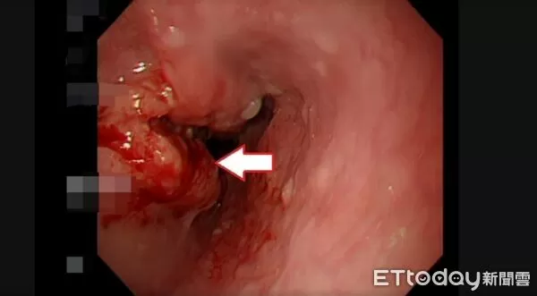 ▲以為胃食道逆流！男子喝水卡卡赫見「癌症3期」 食道慘切除。（圖／亞大附醫提供）
