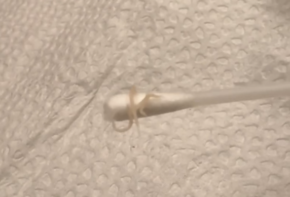 ▲▼正妹媽驚見女兒屁股「爬出蟯蟲」　半夜掏出3、4隻嚇爛。（圖／翻攝自threads）