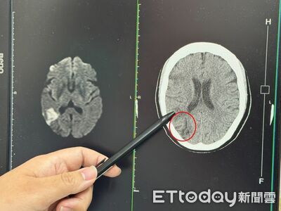 臉沒歪嘴不斜！台中女視力模糊竟是中風　醫警告：再晚就半癱