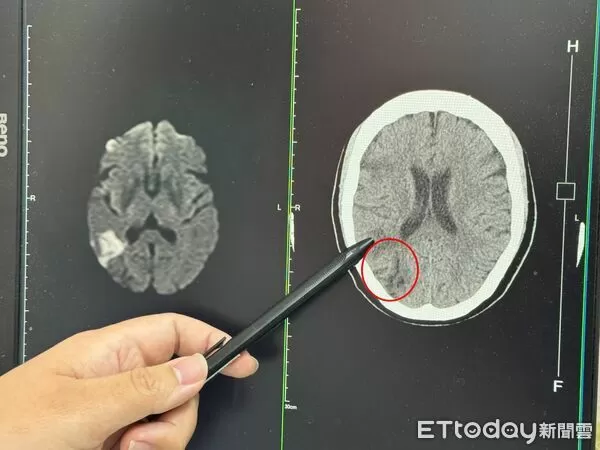 ▲沒有臉歪嘴斜！台中女視力模糊竟是中風　醫警告：再晚就半癱。（圖／李綜合醫院提供）