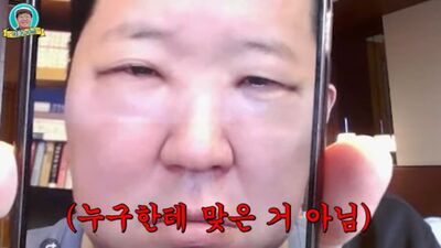 韓男星坦承整形！術後腫到不行「像被暴打」　眼睛慘剩一條縫