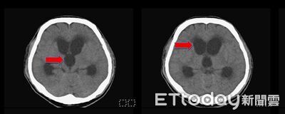 油漆工腦出血拖到變「腦袋進水」意識不清　緊急手術救回一命
