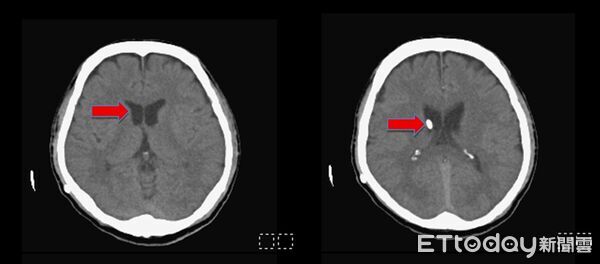 ▲手術後半年，腦部電腦斷層影像顯示，所有脹大的腦室皆已恢復正常大小，可見到所放置右側腦室的導管(紅色箭頭)。（圖／記者許宥孺翻攝）