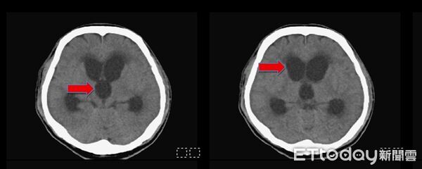 ▲▼油漆工撞破頭拖到「腦袋進水」！。（圖／記者許宥孺翻攝）