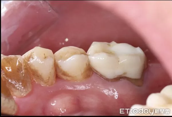 個案女主管未確實清潔牙齒，除了牙齒上有深色茶漬外，牙齒底部有明顯的牙菌斑。（圖／恩主公醫院提供）
