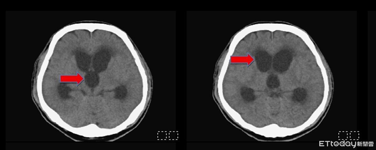 油漆工腦出血拖到變「腦袋進水」意識不清 緊急手術救回一命