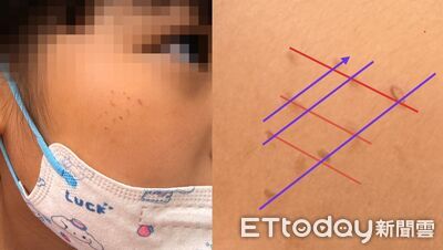 女童臉上「紅疹排排站」不是蟲咬　醫勸：媽媽啊，要換掉它了